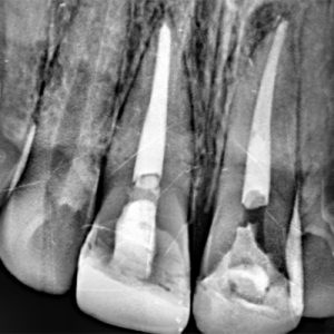 Caso de Endodoncia Tratado en YC Dental Guayaquil