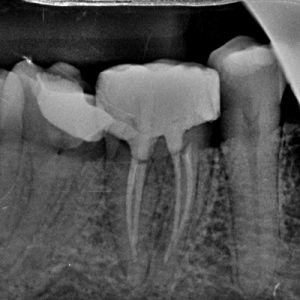 Caso de Endodoncia Tratado en YC Dental Guayaquil