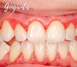 Gingivitis - Periodoncia en Guayaquil - YC Dental