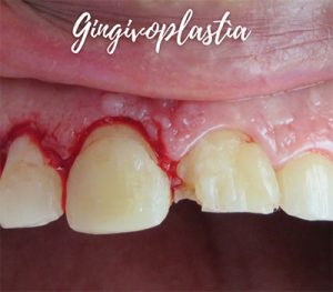 Gingivoplastia - YC Dental - Periodoncia en Guayaquil