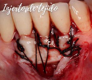 Injerto de tejido - YC Dental - Periodoncia en Guayaquil