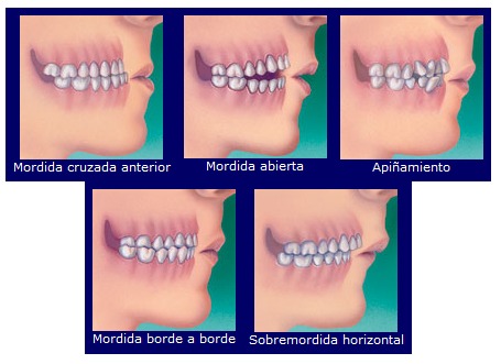 Ortodoncia en Guayaquil - Problemas de la Mordida