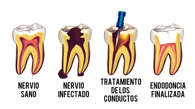 Pasos de la Endodoncia - YC Dental - Guayaquil