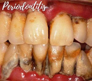 Periodontitis - Periodoncia en Guayaquil - YC Dental