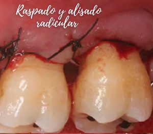 Raspado y Alisado Radicular - YC Dental - Periodoncia en Guayaquil