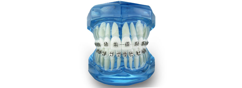 Brackets Autoligado Tipodonto Flair YCDental