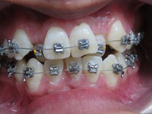 Brackets de Autoligado