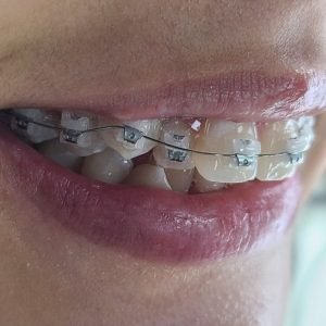 Ortodoncia Estética
