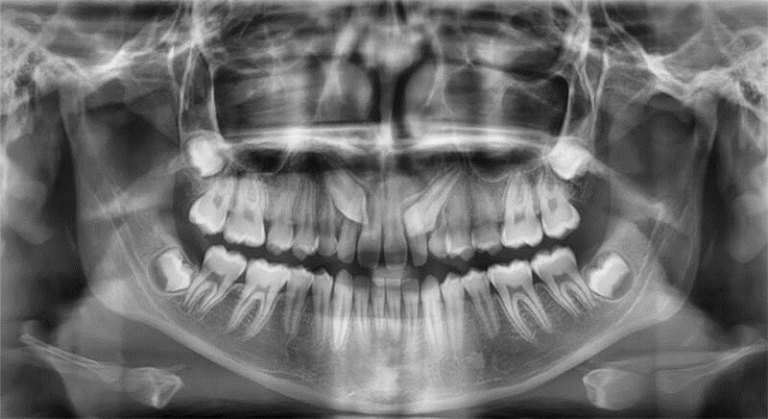 Dientes retenidos, incluidos o impactados. Diagnóstico y tratamiento ...