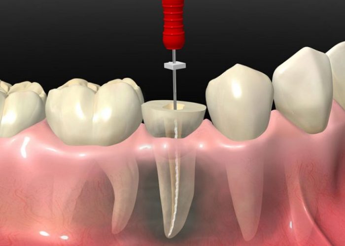 Endodoncia en Guayaquil - YC Dental