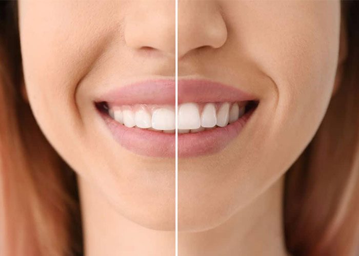 Gingivoplastia y Gingivectomia en Guayaquil-YC Dental